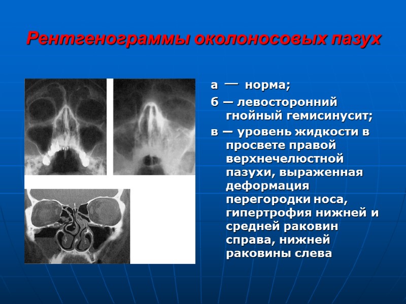 Рентгенограммы околоносовых пазух а — норма; б — левосторонний гнойный гемисинусит;  в —